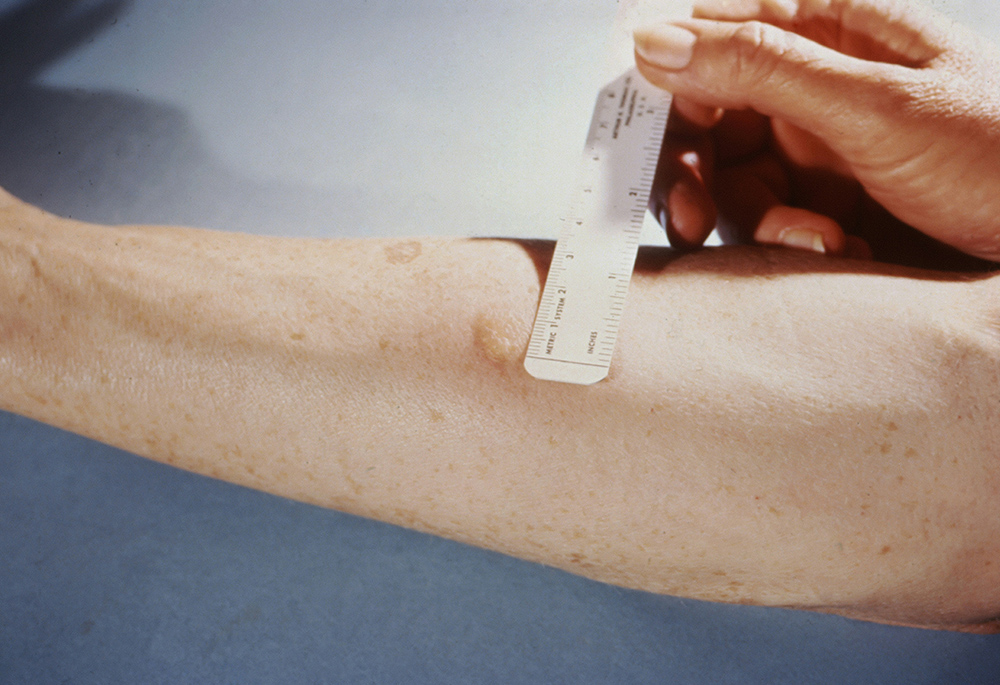 A patient shows a positive reaction to the Mantoux skin test. The test is given via syringe, injecting the testing fluid tuberculin between skin layers. The injection site becomes hard and red in someone with tuberculosis. In Everything is Tuberculosis, John Green educates readers on how TB affects individuals and their communities. (Unsplash/Centers for Disease Control and Prevention)